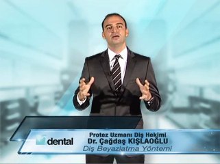 Diş Beyazlatma Yöntemi