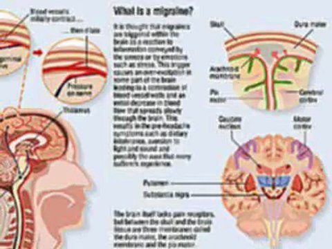 Migraine Headache Treatments, Symptoms