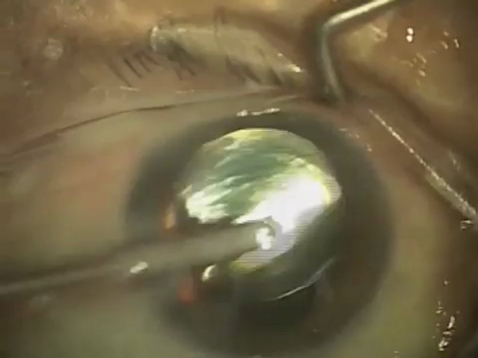 Typical Cataract Surgery (Part 4 of 4) | Dr. David D. Richardson