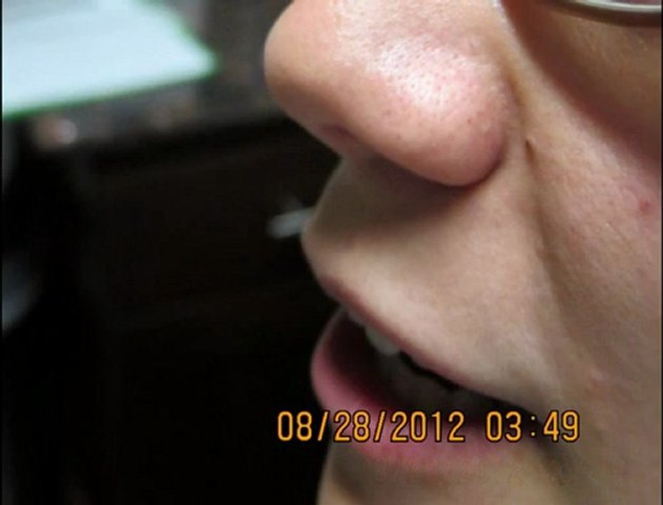 Facial Veins Removal