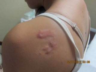 Acne Keloid Scar Removal