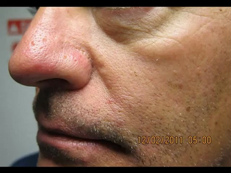Rhinophyma-Rosacea