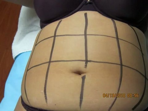 SmartLipo-Abdomen