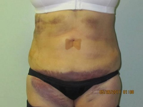 SmartLipo-Abdomen-Flanks