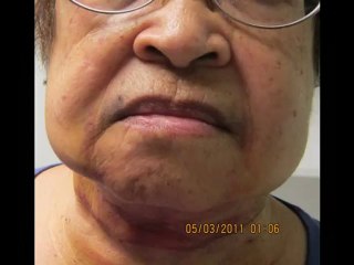 smartlipo-double chin-neck-jowl