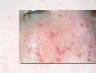 Acne treatments for sensitive skin