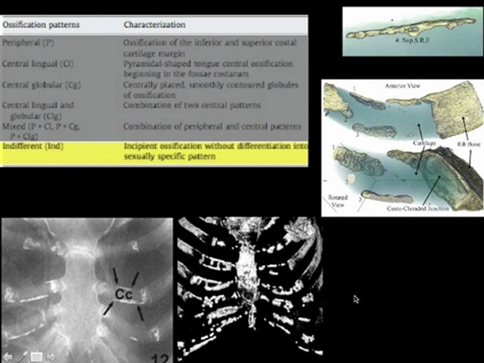 Calcifications du cartilage costal