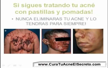 Como Eliminar El Acne Rapido *SECRETO*