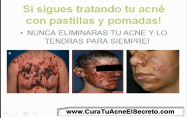 Como Hago Para Eliminar El Acne *AQUI SOLUCION*