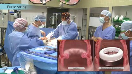 Phase 2 Compression Anastomosis 13_9.wmv
