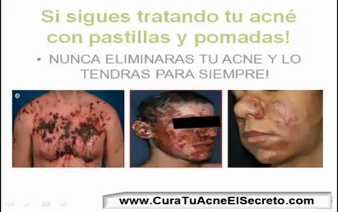 Eliminar Cicatrices De Acne *AQUI LA CURA*