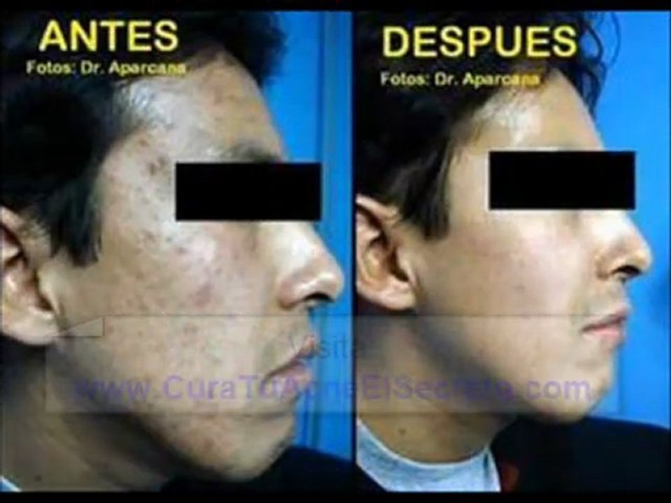 Cura Para El Acne En La Cara