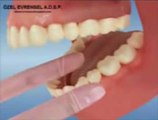 evrensel diş kliniği beylikdüzü diş kliniği,beylikdüzü implant
