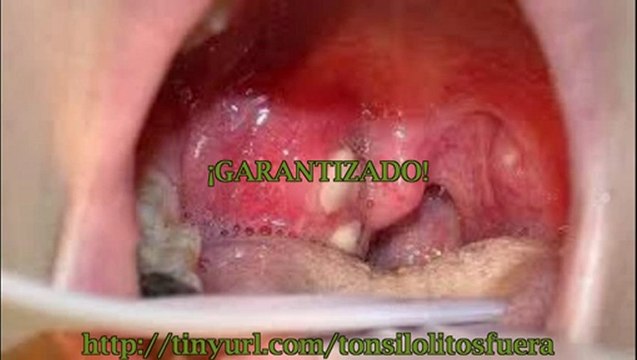 Cálculos amigdalinos remedios caseros