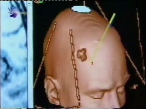 Parkinson: Estimulacion cerebral profunda