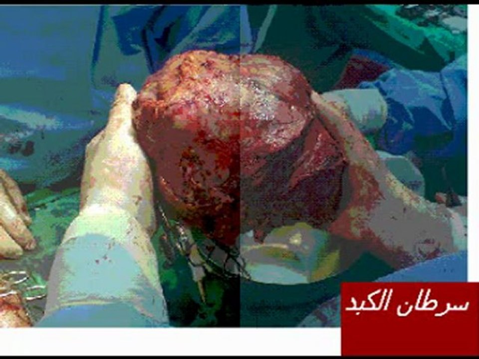 CANCER DU FOIE.CHC-VERSION EN ARABE-Dr AMINE A.-CASABLANCA