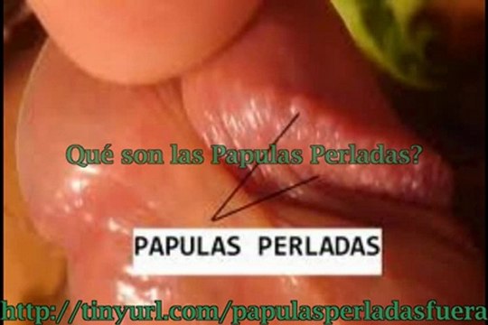 Cura para las papulas perladas