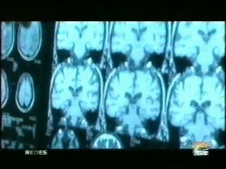 Envejecimiento: Cambios cerebrales