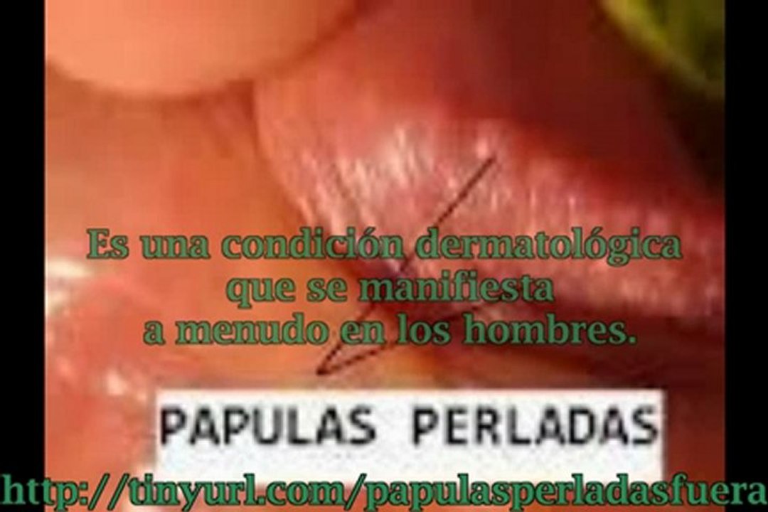 Papulas perladas en el prepucio tratamiento