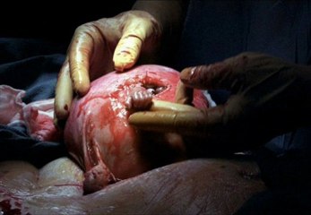 Baby reaches out of womb, grabs doctors finger