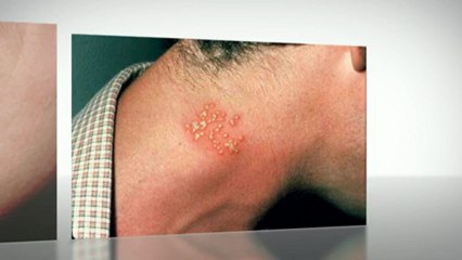 HERPES SYMPTOMS