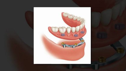 Implant Supported Dentures | Calgary Implant Dentures