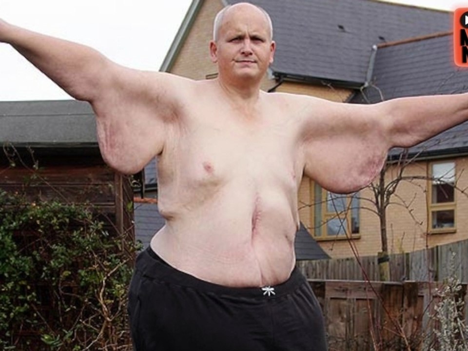 'World's Fattest Man' Loses 650 lbs.