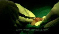 Surgery of Fibroid in Breast-hdv-fx-1-01-1.flv