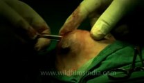 Surgery of Fibroid in Breast-hdv-fx-1-01-11.flv