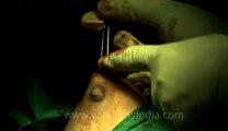 Surgery of Fibroid in Breast-hdv-fx-1-01-15.flv