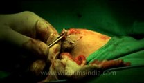 Surgery of Fibroid in Breast-hdv-fx-1-01-16.flv