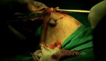 Surgery of Fibroid in Breast-hdv-fx-1-01-17.flv
