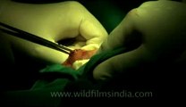 Surgery of Fibroid in Breast-hdv-fx-1-01-2.flv