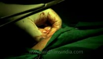 Surgery of Fibroid in Breast-hdv-fx-1-01-20.flv