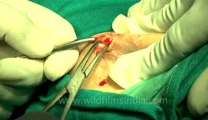 Surgery of Fibroid in Breast-hdv-fx-1-01-26.flv