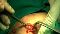 Surgery of Fibroid in Breast-hdv-fx-1-01-29.flv