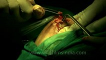 Surgery of Fibroid in Breast-hdv-fx-1-01-3.flv