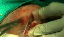 Surgery of Fibroid in Breast-hdv-fx-1-01-31.flv