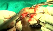 Surgery of Fibroid in Breast-hdv-fx-1-01-32.flv