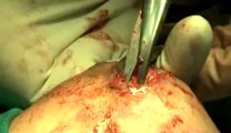 Surgery of Fibroid in Breast-hdv-fx-1-01-35.flv