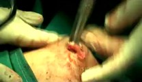 Surgery of Fibroid in Breast-hdv-fx-1-01-36.flv