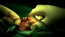 Surgery of Fibroid in Breast-hdv-fx-1-01-4.flv