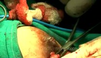 Surgery of Fibroid in Breast-hdv-fx-1-01-41.flv