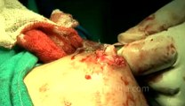 Surgery of Fibroid in Breast-hdv-fx-1-01-43.flv