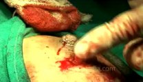 Surgery of Fibroid in Breast-hdv-fx-1-01-44.flv
