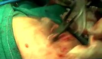 Surgery of Fibroid in Breast-hdv-fx-1-01-49.flv