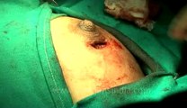 Surgery of Fibroid in Breast-hdv-fx-1-01-51.flv