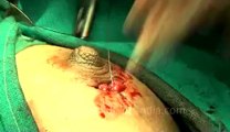Surgery of Fibroid in Breast-hdv-fx-1-01-52.flv