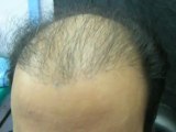 How to correct bad hairline to Natural hair transplant in Pakistan  Part#1