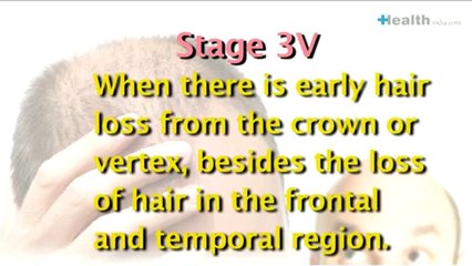 Do you have male pattern baldness-.mp4